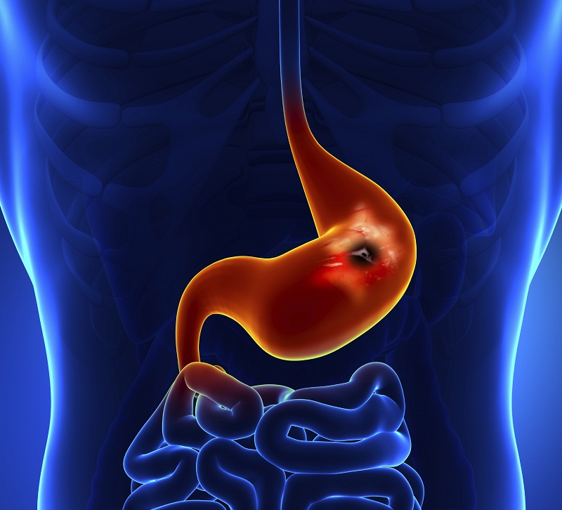 stomach_cancer.jpg