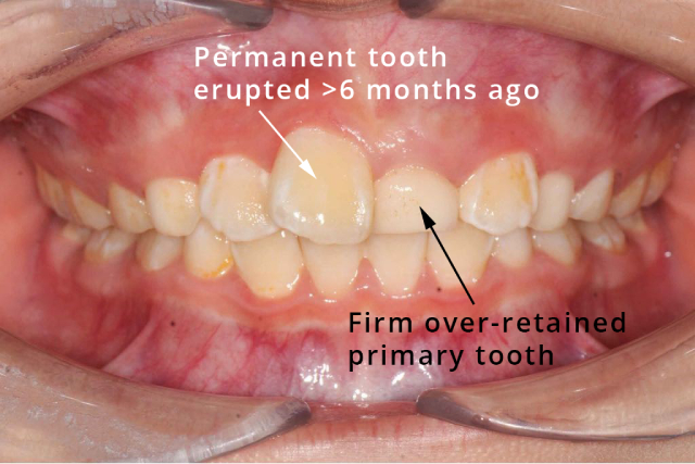 A child with both milk teeth and permanent teeth. Sometimes, certain situations may require a dentist to extract a milk tooth.