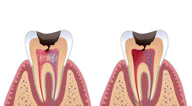 cavitiy illustration.jpg