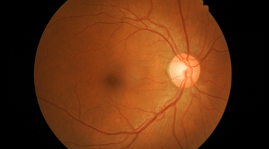 retinopathy.jpg