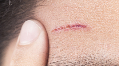 forehead_injury.jpg