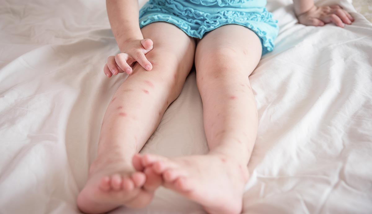 mosquito-bites-on-childs-leg.jpg