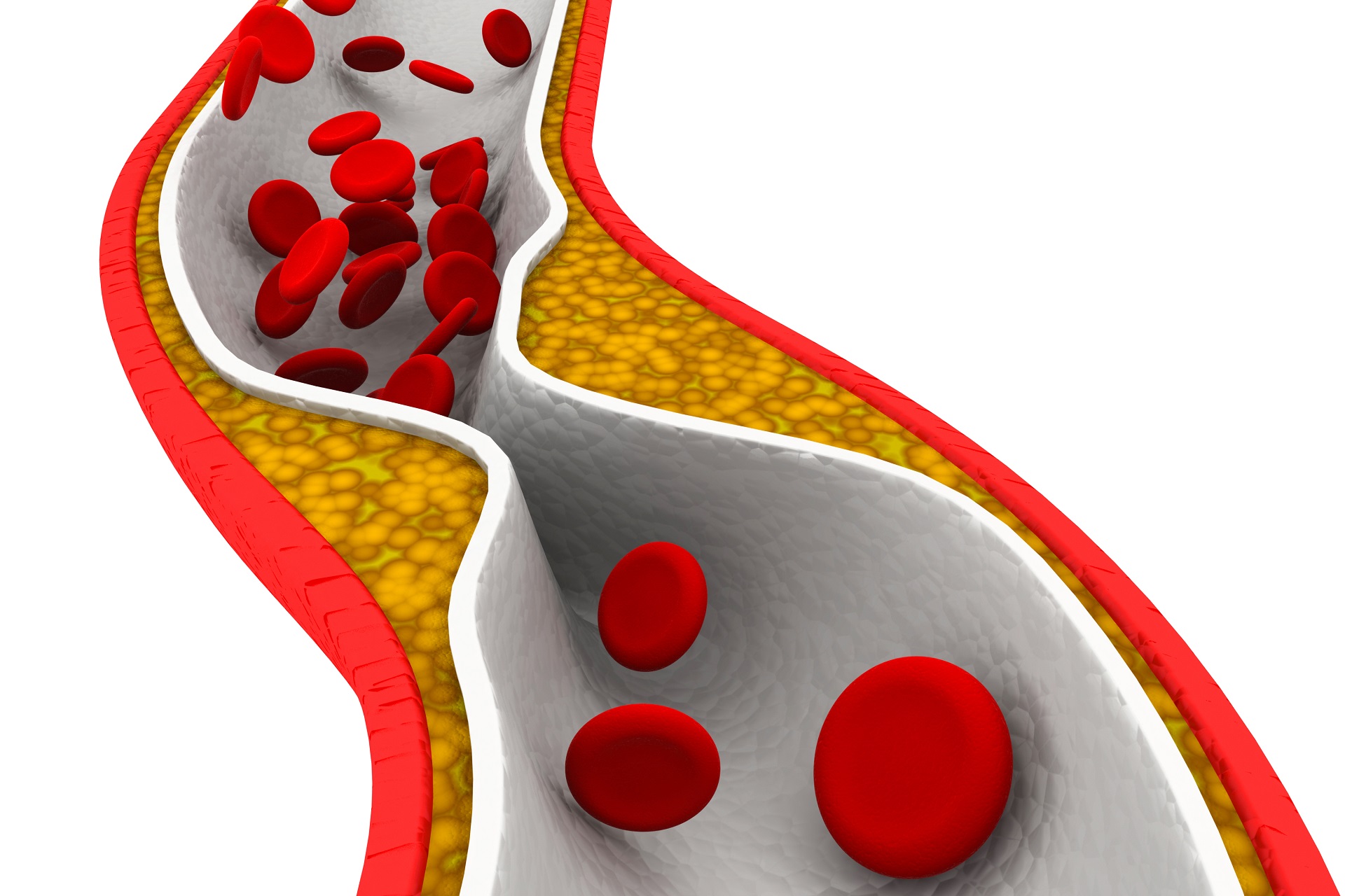 carotidarterydisease.jpg