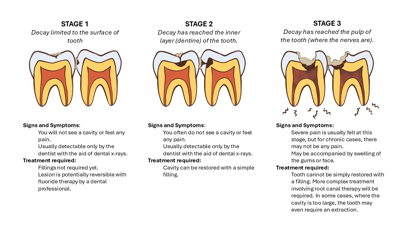 Caries Progression
