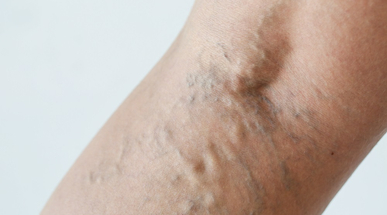 varicoseveins.jpg