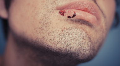 cold_sore_and _blood.jpg